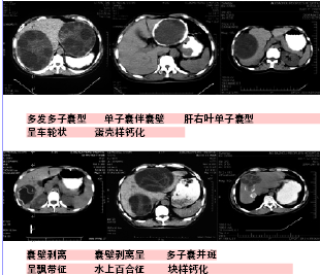 火山视频:2004新澳精准资料免费提供-肝内多发低密度灶是什么意思