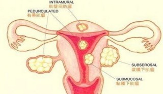 搜狐:2024新澳精准资料免费大全-什么是子宫肌瘤