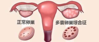 微博:2024年新澳门今晚免费资料-多囊卵巢是什么意思