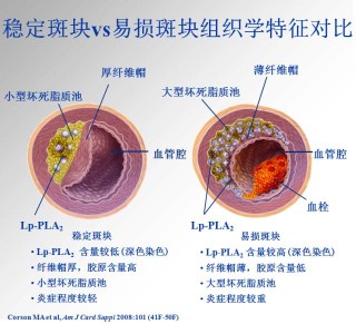 火山视频:香港好彩二四六免费资料大全澳门-脂蛋白磷脂酶a2高说明什么