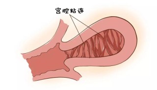 中新网:2024新澳门资料大全-宫腔粘连有什么症状