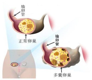 微博:2024年新澳门今晚免费资料-多囊卵巢是什么意思