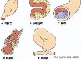 腾讯：澳门正版资料免费大全精准-肠梗阻是因为什么原因引起的