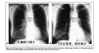 网易:澳门2024正版资料王中王-两肺少许纤维灶是什么意思