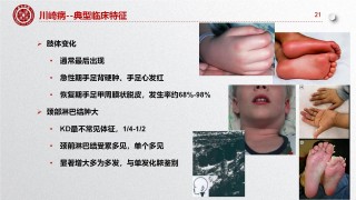 百家号:新澳门王中王资料公开-川崎病是什么原因引起的